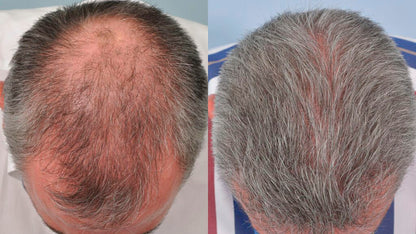 Red Light Therapy Hair Growth Cap